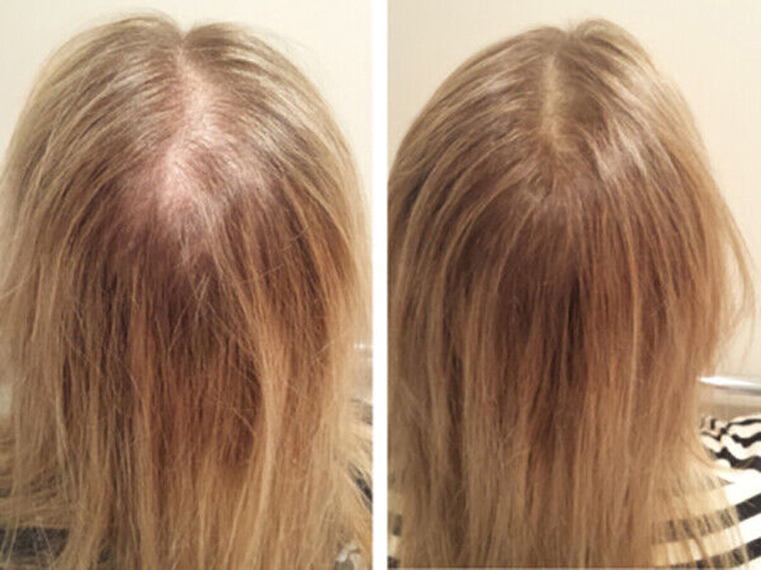 DAROXIL-16 Champú y Acondicionador Anticaída – Regeneración Total del Cabello