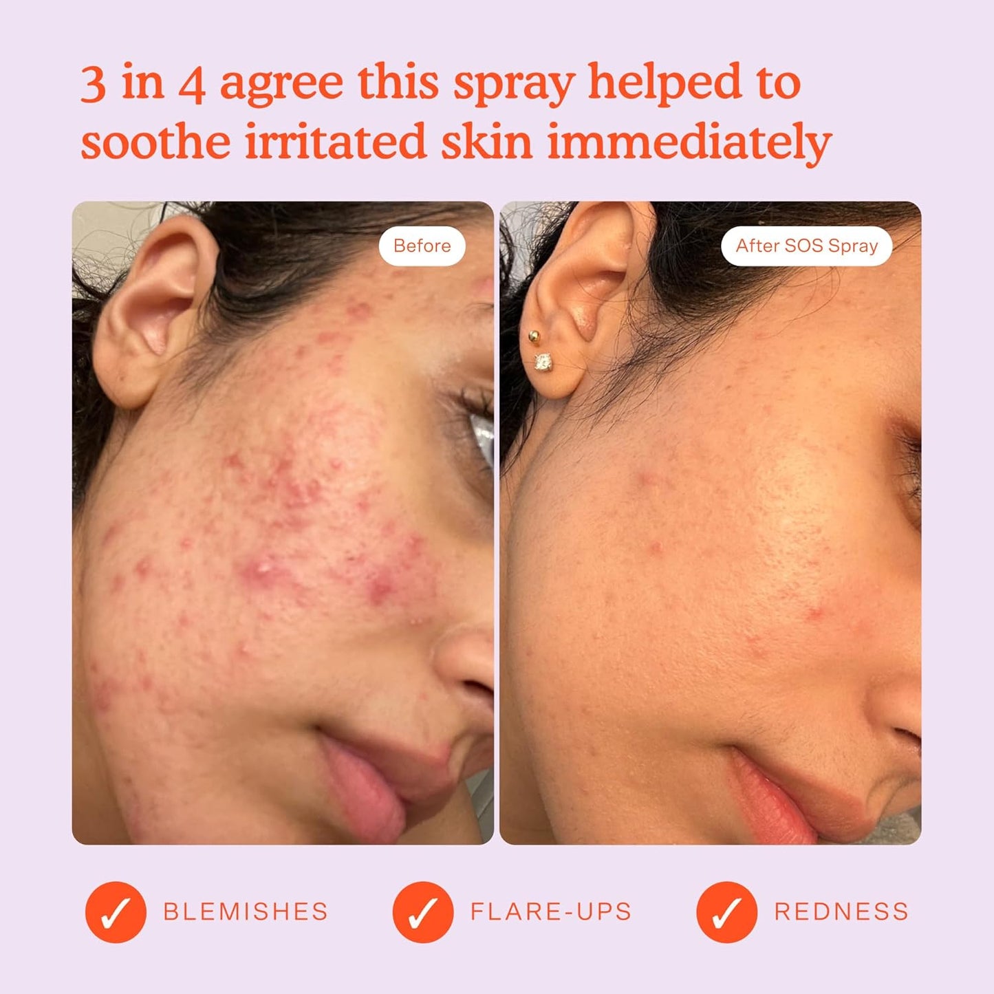 SOS diario - Spray facial para pieles sensibles - Ac hipocloroso - Reducción de enrojecimiento