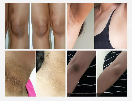 Dark Skin Ultra Whitening Gel Cream - Blanqueamiento de Piel