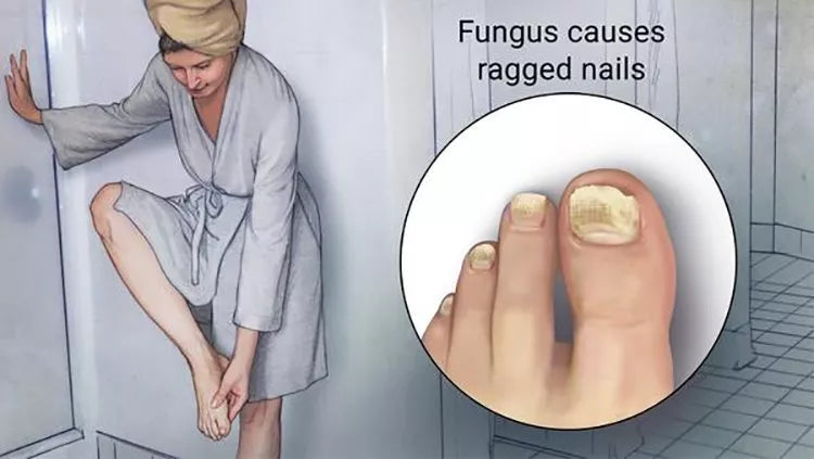 FungusCure RX - Tratamiento Hongos de Uñas