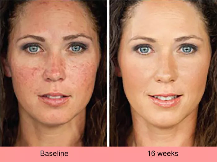 Serum Ultra Iluminador con Ácido Kójico