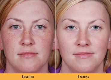 Serum Ultra Iluminador con Ácido Kójico