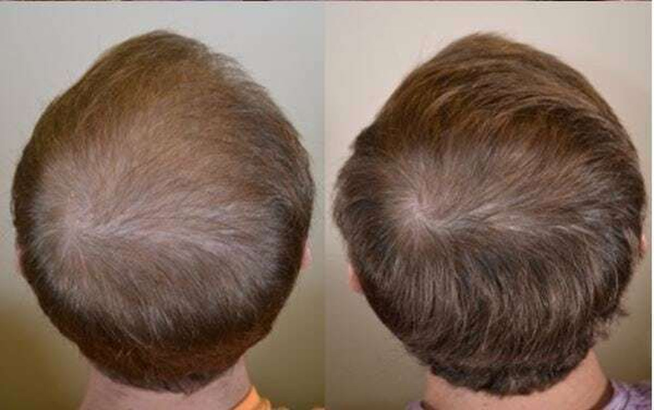 DAROXIL-16 Champú y Acondicionador Anticaída – Regeneración Total del Cabello