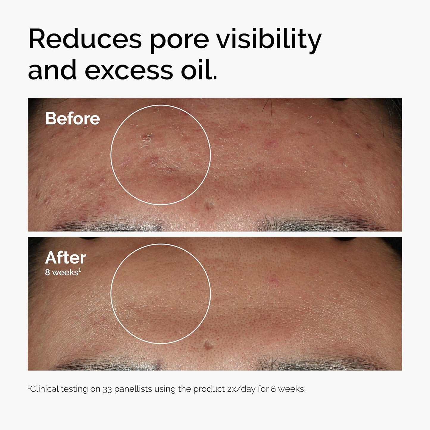 The Ordinary Niacinamide 10% + Zinc 1% | Sérum Facial Anti-Imperfecciones – Control de Sebo, Reducción de Poros y Textura Suave – 30 ml