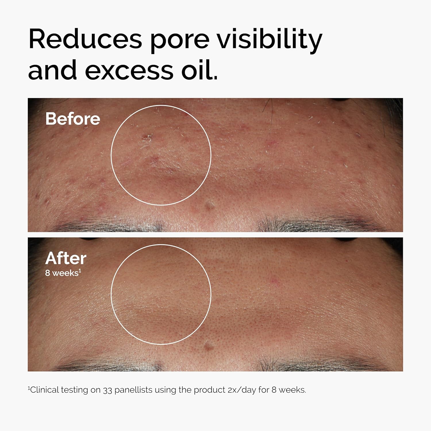 The Ordinary Niacinamide 10% + Zinc 1% | Sérum Facial Anti-Imperfecciones – Control de Sebo, Reducción de Poros y Textura Suave – 30 ml