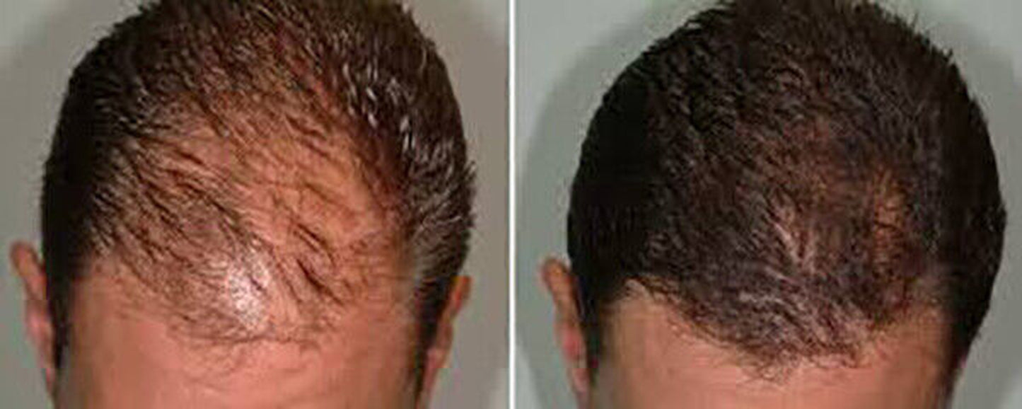 DAROXIL-16 Champú y Acondicionador Anticaída – Regeneración Total del Cabello