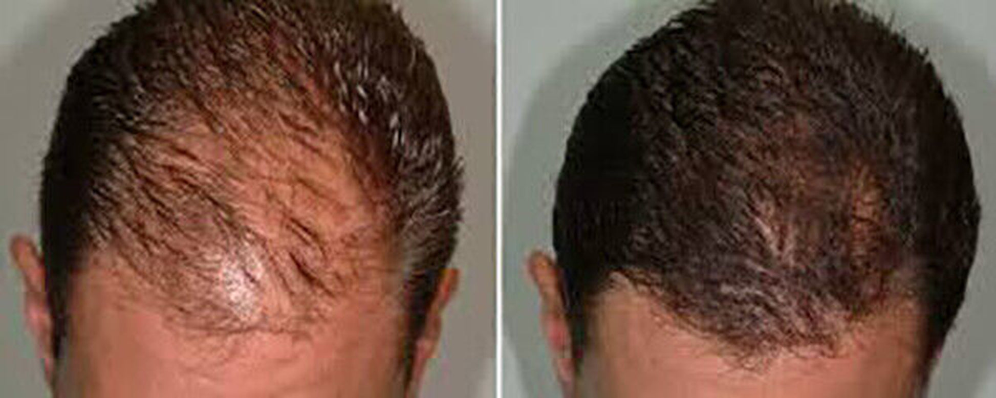 DAROXIL-16 Champú y Acondicionador Anticaída – Regeneración Total del Cabello
