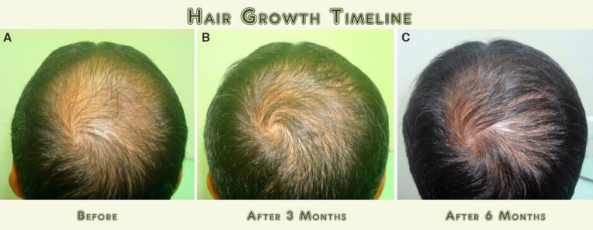 DAROXIL-16 Champú y Acondicionador Anticaída – Regeneración Total del Cabello