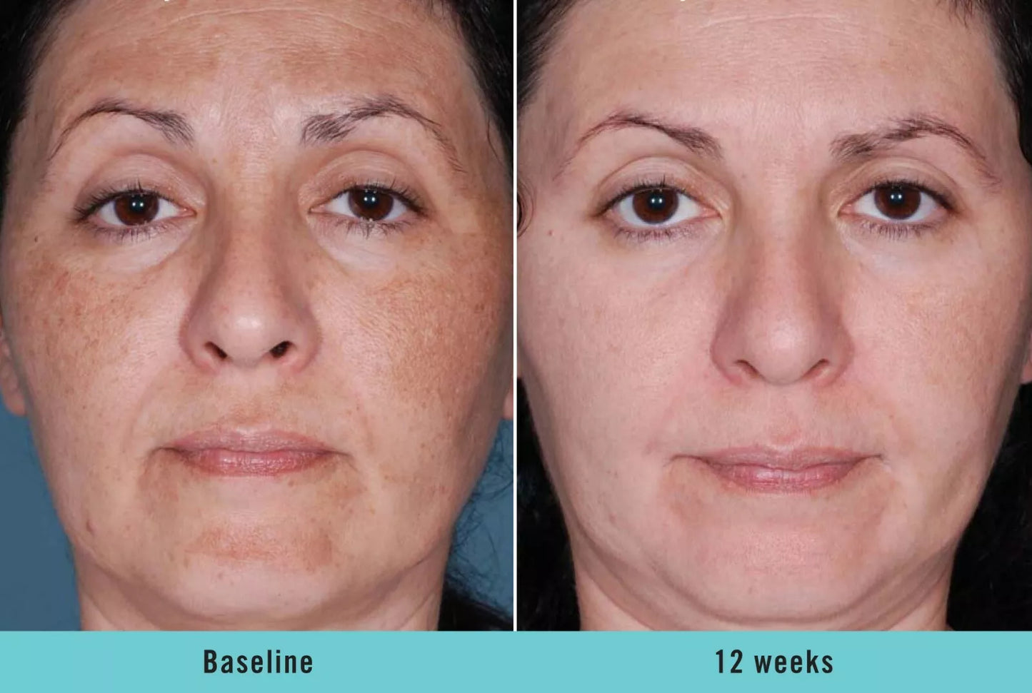 Serum Ultra Iluminador con Ácido Kójico