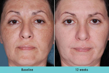 Serum Ultra Iluminador con Ácido Kójico